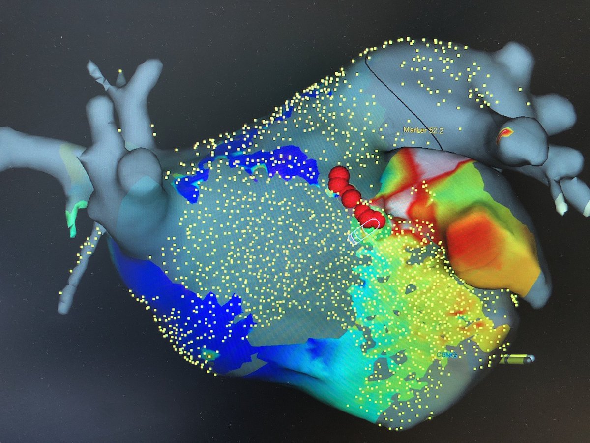 Phiso_de's tweet photo. At LAA base the #HDGrid covered 175ms of cycle length... 1 RF terminated the tachycardia. #loveHDmapping #EPisfun https://t.co/f1ZCYLWU5w