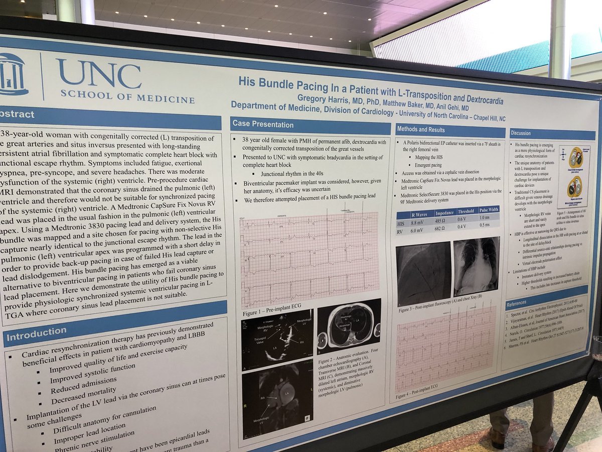drgregharris's tweet photo. My poster on His bundle pacing in a patient with L transposition and dextrocardia. #dontdisthehis https://t.co/FEeNAUTXNG