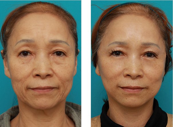 bgtrs.pro/?target=-7EA5Q…  Japon kozmetik urunleri dunya capinda cok unludur. Urettikleri sadece bb kremi degildir bunun yaninda kisisel yuz bakim urunleride uretmektedirler.