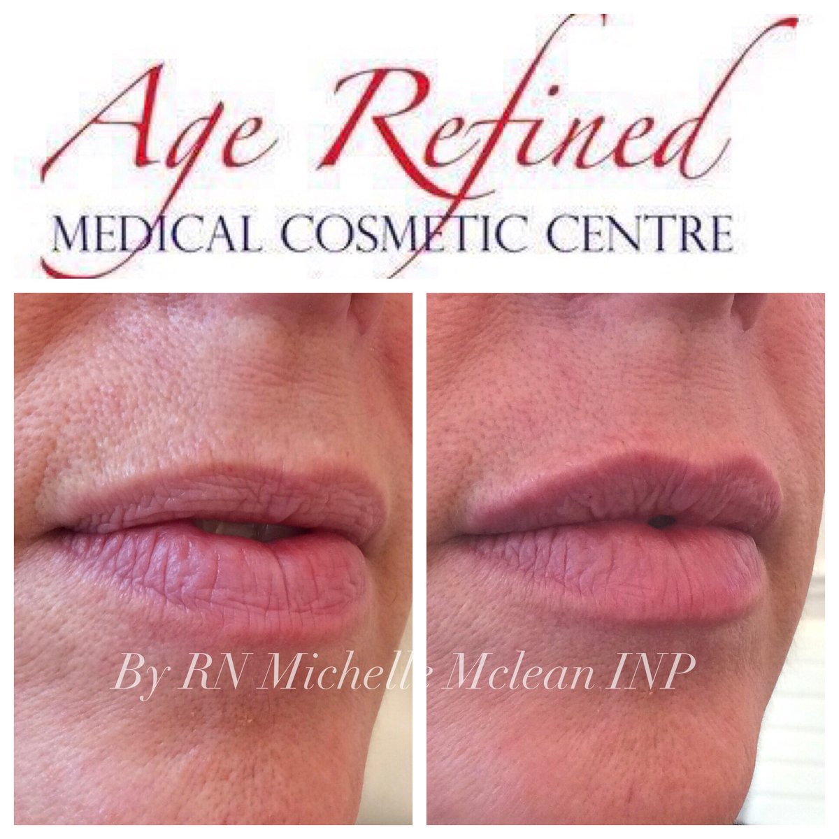 AgeRefined's tweet photo. A lovely natural enhancement using only 0.55mls of dermal filler results lasting over 12 months.  #dermafillerlips #naturallips https://t.co/YtiQ1sZHLx