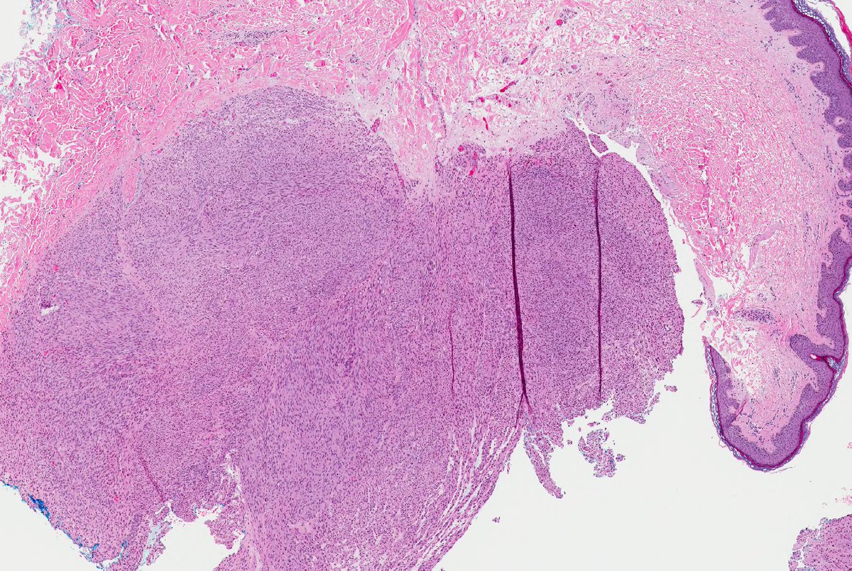 SteveBillingsMD's tweet image. Remember leiomyosarcomas arising from vessels may be aggressive unlike leiomyosarcoma from arrector pili. This LMS arising from vein; note residual vascular wall at periphery.  Residual vein top left corner on image 2 &amp;amp; 3. Ref: Italiano A, et al. PubMed PMID: 20167595. #dermpath