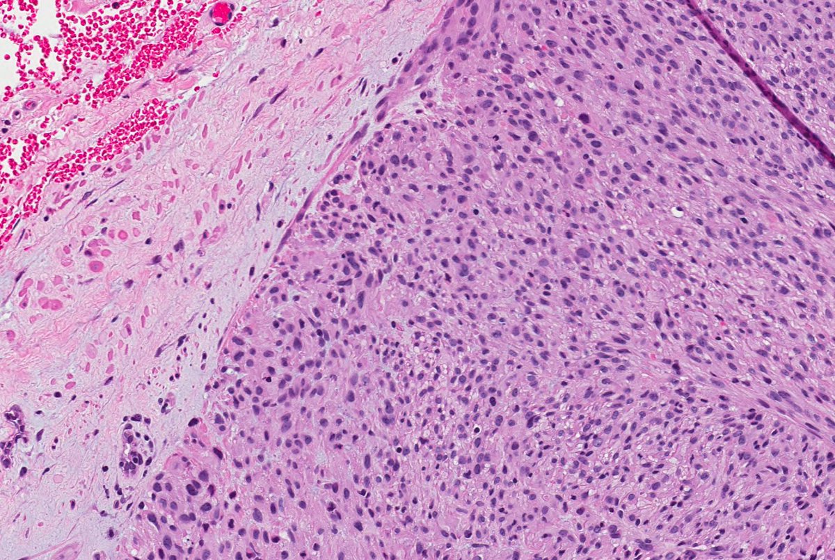 SteveBillingsMD's tweet image. Remember leiomyosarcomas arising from vessels may be aggressive unlike leiomyosarcoma from arrector pili. This LMS arising from vein; note residual vascular wall at periphery.  Residual vein top left corner on image 2 &amp;amp; 3. Ref: Italiano A, et al. PubMed PMID: 20167595. #dermpath