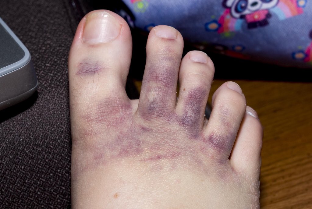 BriansBalls1's tweet photo. @Rubbish_skip @saint_retton @RichardMarcer @jonk666 @MillHillMole @chambersjohn3 I think Matt Warings toes will look like this in the morning. Needs to get em soaked in cider to get the bruising out. That’s what I’ve got my ‘balls’ floating in 🤪 https://t.co/gW9i2OAQJW