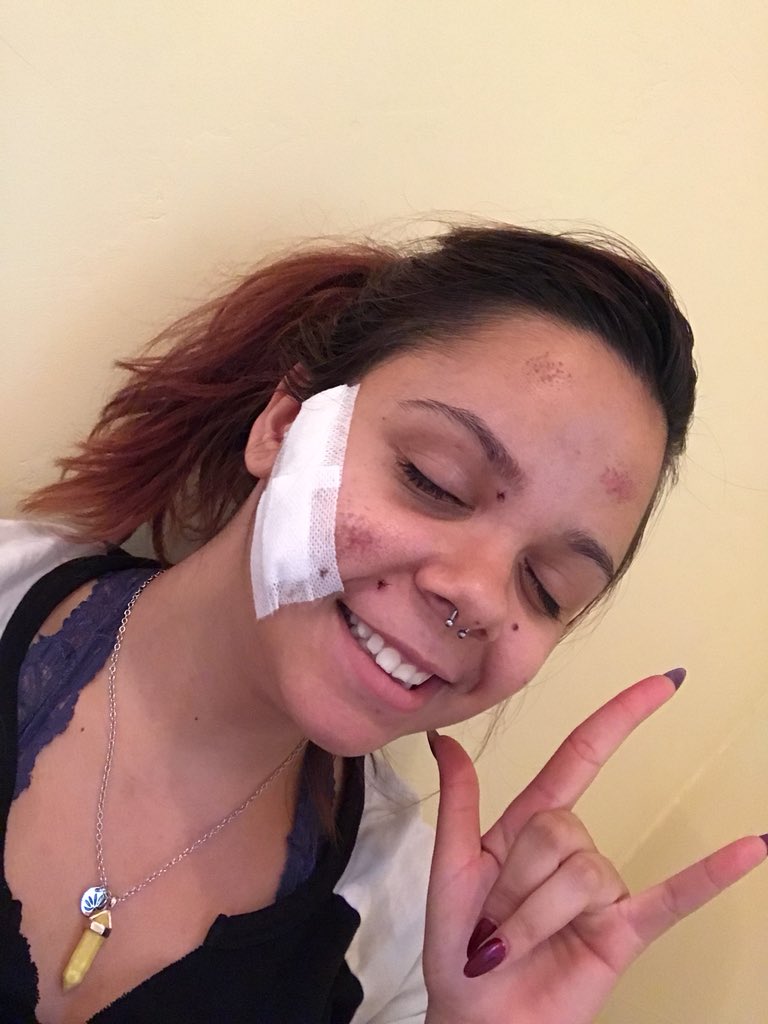 funkpuncher's tweet photo. My face is finally shrapnel free! Regardless of the fact I look like I lost a fight, inside I’m winning in a way. I’ve been struggling so hard to love my face again, thank you for all your support. https://t.co/3Y7q7fNniq