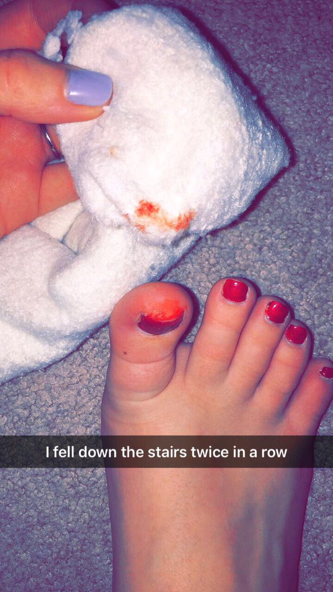 kmariestacey's tweet photo. You know it was a hard fall when you fell up carpet stairs and ended up with a bloody toe https://t.co/NrhoWoxK6Y