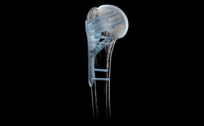 Medartis_Global's tweet photo. Proximal Humerus System 3.5 - optional spiral blade possibilities with 40° or 50°.
Rethink your technique: https://t.co/RanwFqUvxe https://t.co/EfUdJTovj3