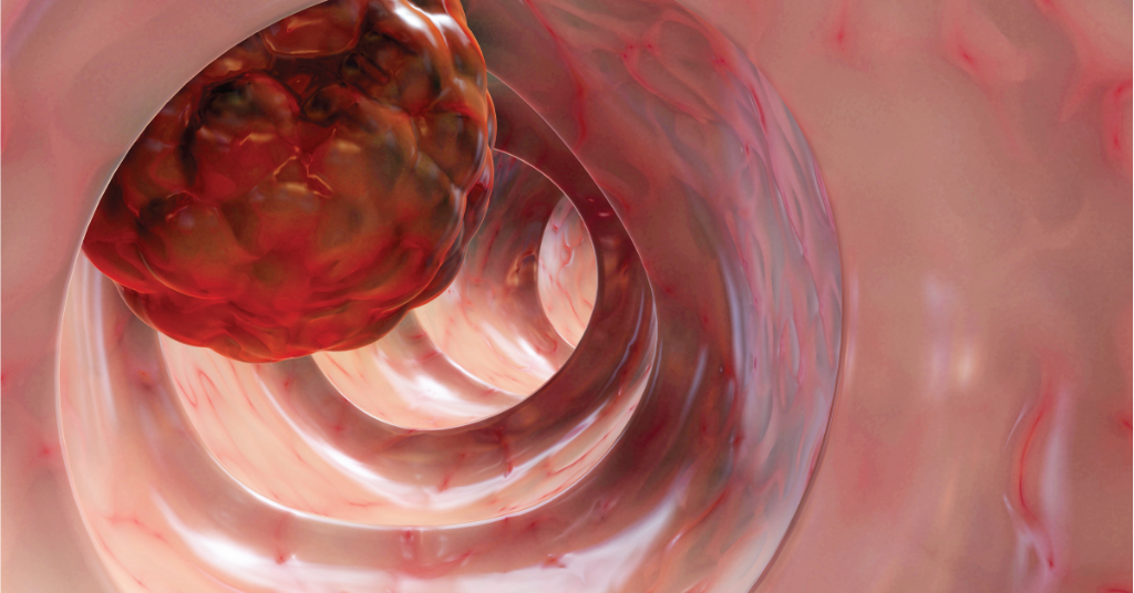 WebMD's tweet photo. By 2030, colorectal cancer incidence rates will be up 90% in people between ages 20 and 34, and 28% for people between ages 35 and 49 -- and some clues why are starting to emerge. https://t.co/BV48V0yI7X https://t.co/fR5rOkc7Q9