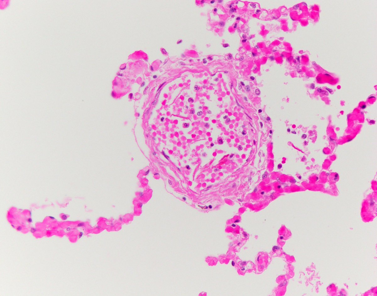 Image of the day, for Mother's Day: amniotic fluid embolism, among the most poorly-understood causes of maternal mortality. Despite its rarity (~1/20,000 births), it causes 10 percent of maternal deaths #forensic #pathology #histology