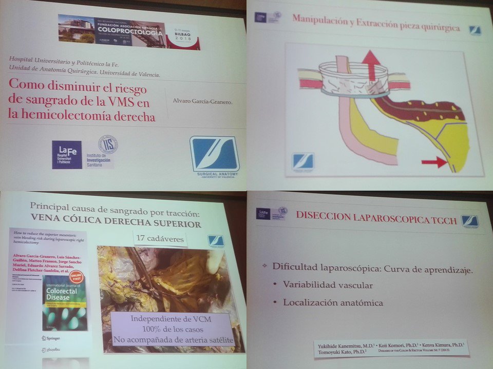 GianlucaPellino's tweet photo. Fantastic presentation @ #rnaec2018 by Álvaro García-Granero
How to prevent SMV bleeding during right hemicolectomy
#colorectalsurgery #colorectalresearch
enjoy videos & articles here:
https://t.co/O1qZInBJ3y
https://t.co/wVnxJuP9As
much learned during dissections together https://t.co/gk0J5E5lmJ