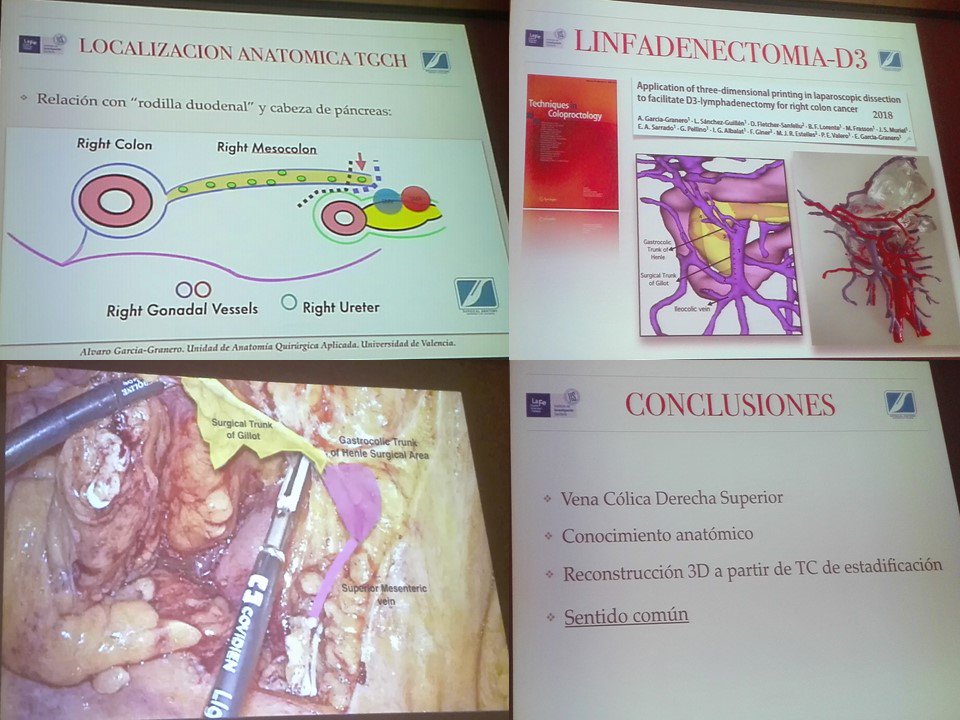 GianlucaPellino's tweet photo. Fantastic presentation @ #rnaec2018 by Álvaro García-Granero
How to prevent SMV bleeding during right hemicolectomy
#colorectalsurgery #colorectalresearch
enjoy videos & articles here:
https://t.co/O1qZInBJ3y
https://t.co/wVnxJuP9As
much learned during dissections together https://t.co/gk0J5E5lmJ
