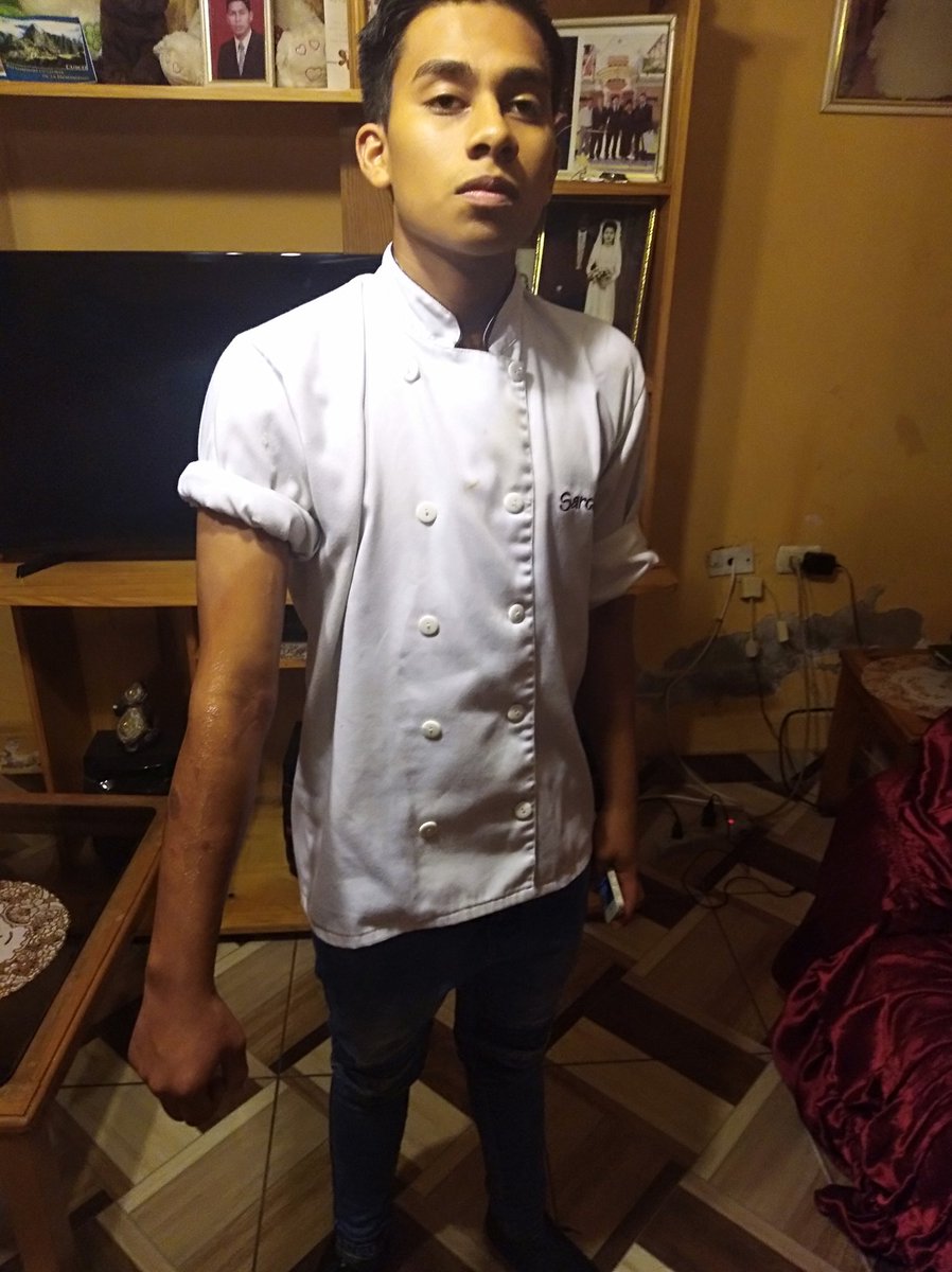 acossiop's tweet photo. #Sarclettinuncamás Mi primo, cocinero de Sarcletti, se quemó el brazo derecho hoy al mediodía mientras preparaba unos saltados. Que hicieron? NADA. Lo obligaron a trabajar 5 horas más y luego le dieron 10 soles para que vaya atenderse y que diga que no fue accidente de trabajo!!! https://t.co/e5yX5luzMG