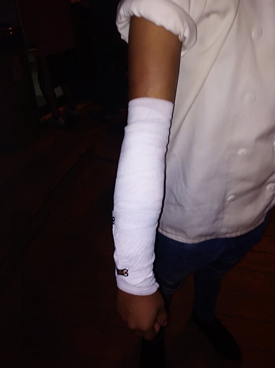 acossiop's tweet photo. #Sarclettinuncamás Mi primo, cocinero de Sarcletti, se quemó el brazo derecho hoy al mediodía mientras preparaba unos saltados. Que hicieron? NADA. Lo obligaron a trabajar 5 horas más y luego le dieron 10 soles para que vaya atenderse y que diga que no fue accidente de trabajo!!! https://t.co/e5yX5luzMG