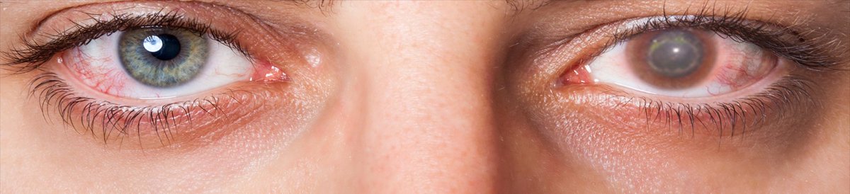 OphthalmoNeuro's tweet photo. #Acanthamoeba #eyeinfections in contact lens it is rare but serious and they often start because of improper lens handling and poor hygiene
#Neurology #Ophthalmology #Diplopia #OpticNeuropathy #Acupuncture #VisualNeuroscience #VisualSystem
Visit @ https://t.co/xxKqHM8EfD https://t.co/Szx6GAg9cL