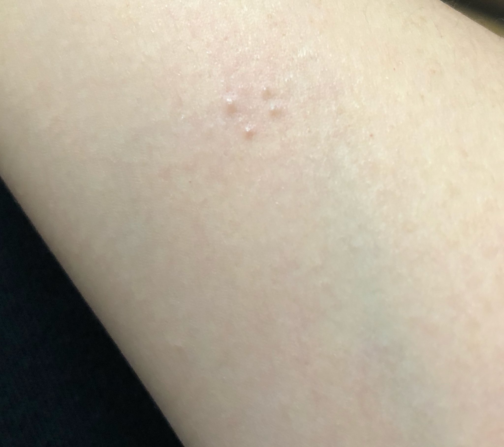 えりか なに このブツブツ 痒い 急に出てきた 怖い T Co L0v9khd5ss Twitter えりか なに このブツブツ 痒い 急に出てきた 怖い T Co L0v9khd5ss Twitter