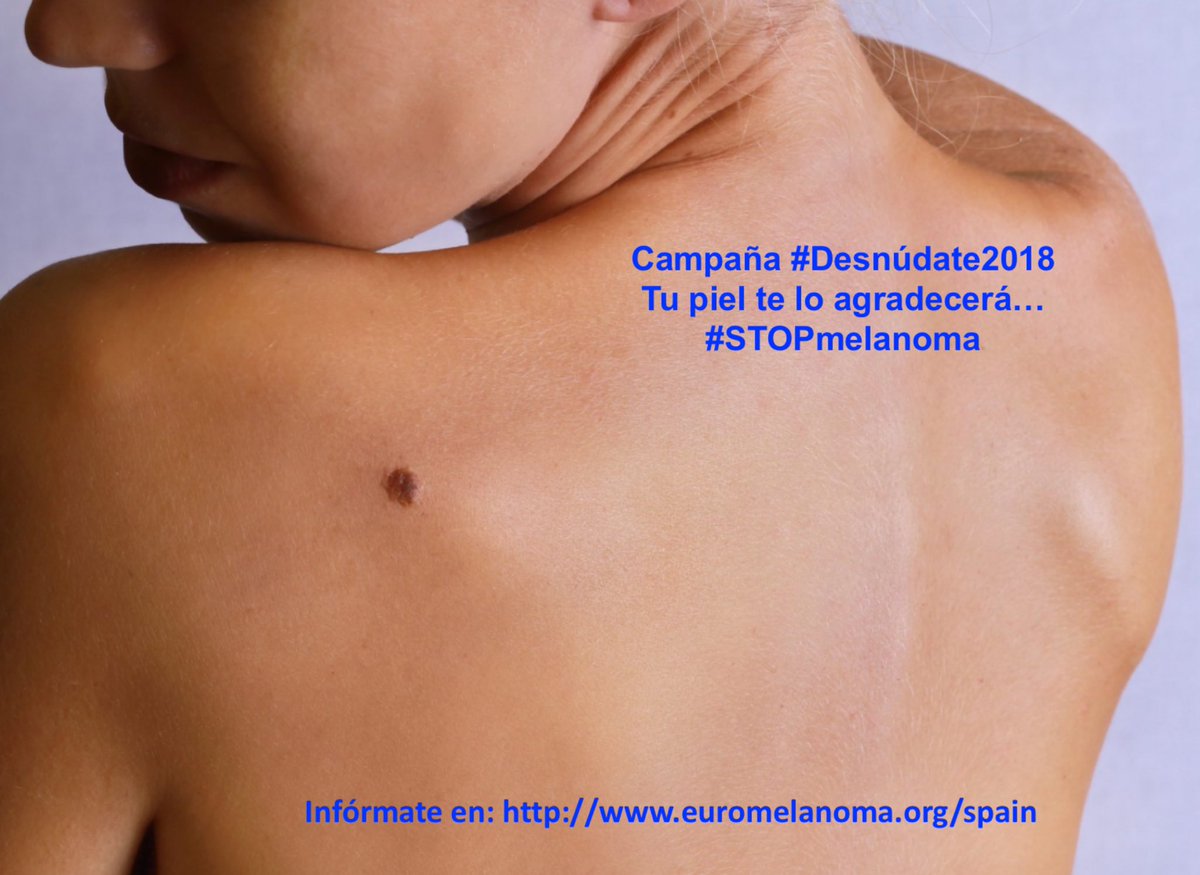 Empezamos la campaña 2018 para luchar contra la forma más agresiva de cáncer de piel, el #melanoma. ⛔️
Lo más importante: el diagnóstico precoz. Para ello: #Desnúdate2018 
🚩🚩🚩 (y revisa tus lunares!) 👁👁
#STOPmelanoma #Euromelanoma2018 #dermatologia
euromelanoma.org/spain