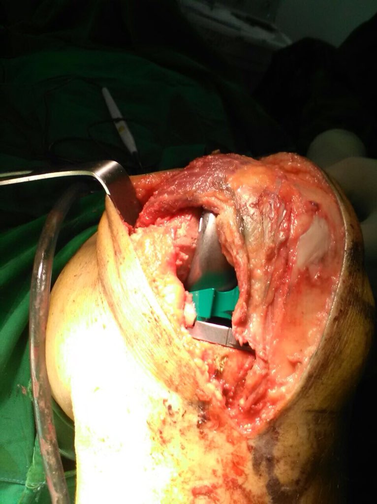 JuancgomezMD's tweet photo. Today in #OR #subvastus #AnteriorStabilized #PCL #sacrificing Vanguard total knee arthroplasty https://t.co/S79gJRpb7w