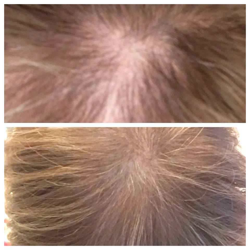 QuestTwoHealth's tweet photo. Experiencing Hair Loss?  Then you need to look into our Stem Cell Enhancer, that is proving to stimulate hair growth and stop hair loss!  Several testimonials confirm! DM me for info! https://t.co/y3CpXCuB9Q