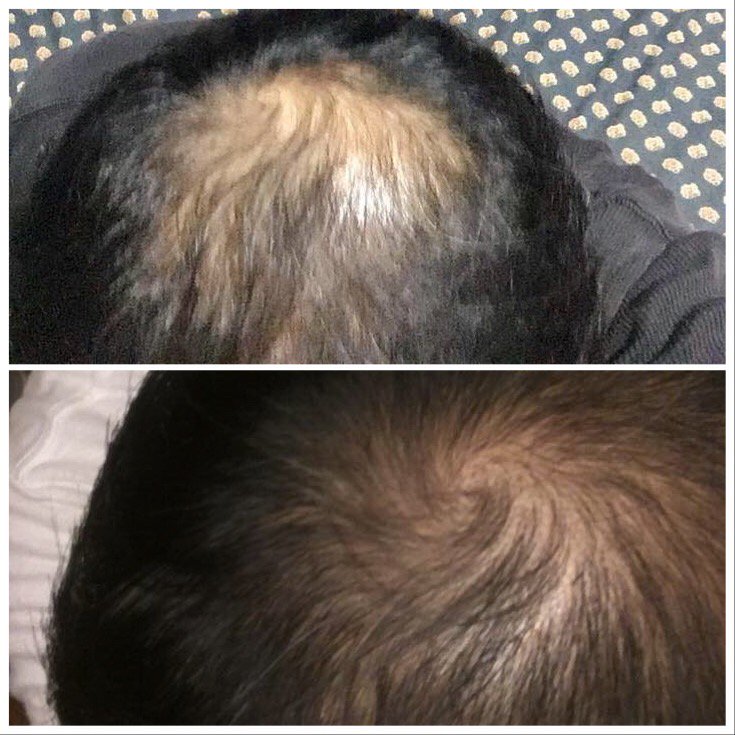 QuestTwoHealth's tweet photo. Experiencing Hair Loss?  Then you need to look into our Stem Cell Enhancer, that is proving to stimulate hair growth and stop hair loss!  Several testimonials confirm! DM me for info! https://t.co/y3CpXCuB9Q