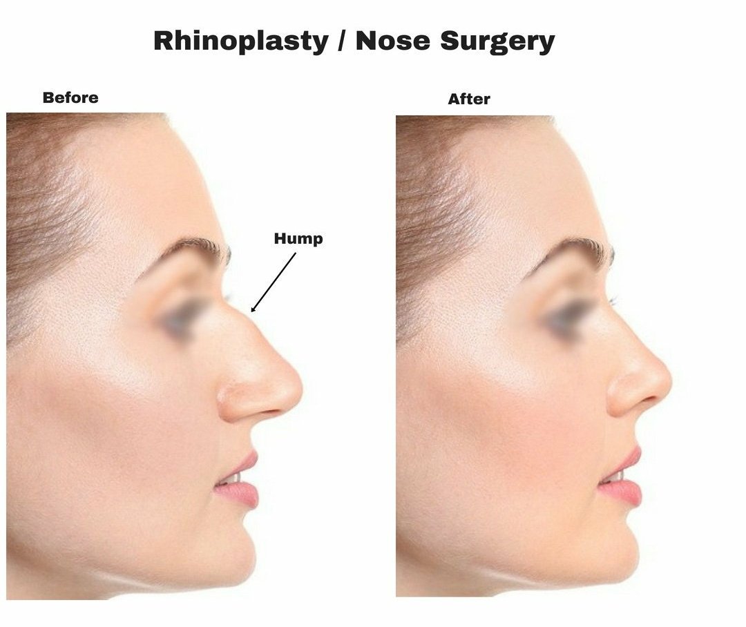 ryangary79's tweet photo. Enhance your nose shape and give your face a balanced look with rhinoplasty.
#CosmeticSurgeryForeign #cosmeticsurgery #surgery #nosesurgery #rhinoplasty #rhinoplastysurgery #rhinoplastyspecialist #rhinoplastyindia #rhinoplastyexpert https://t.co/ODob7jQZM6
