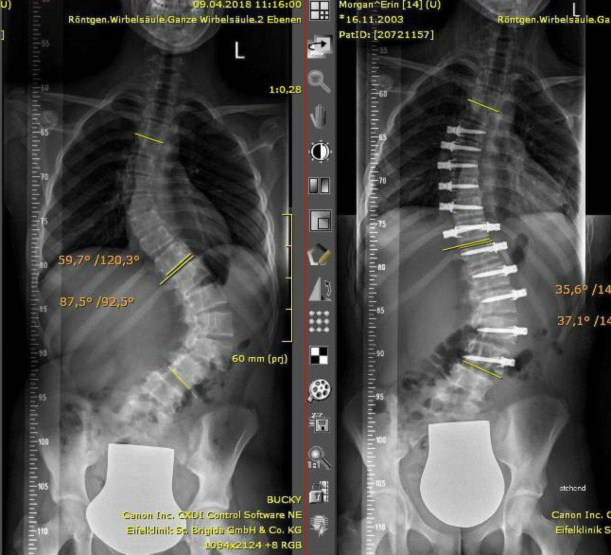 So emotional to see Erin back at school just five weeks post op after having her VBT spinal correction. @whs_cardiff  thank you to Mr O'Rourke and Miss Flannagan for taking such good care of her. @WhitchurchPE I'm sure Erin will be back to 'flicking' very soon!😉🤸‍♂️💚💚