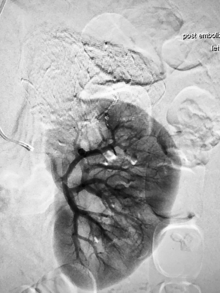 AlexCVIR's tweet photo. @drjaminb Embolization is performed every day by Interventional Radiologists for a variety of conditions including AML. The very same procedure was performed today for one of our patients as an elective outpatient procedure. Best wishes for a speedy recovery @FLOTUS. #IRad @SIRspecialists https://t.co/5dqYl1GPoR