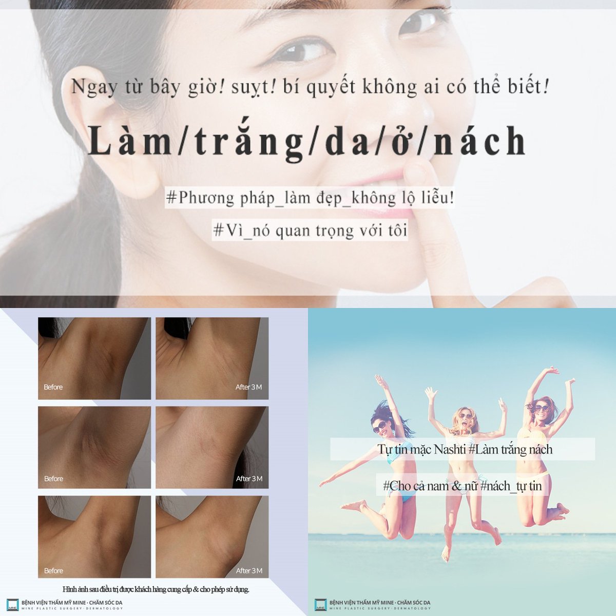 TMMINE1176's tweet photo. Nỗi lo lắng khi mùa hè đến bạn không thể thể tự tin khi vươn tay😥😥
#tưvanphauthuat #benhvienthammy #điềutrịda #chămsócda #làmdatrắng #kangnamhànquốc #bệnhviệnmine #mineps #Bệnhviện_mine https://t.co/r5Cn3jEnl9