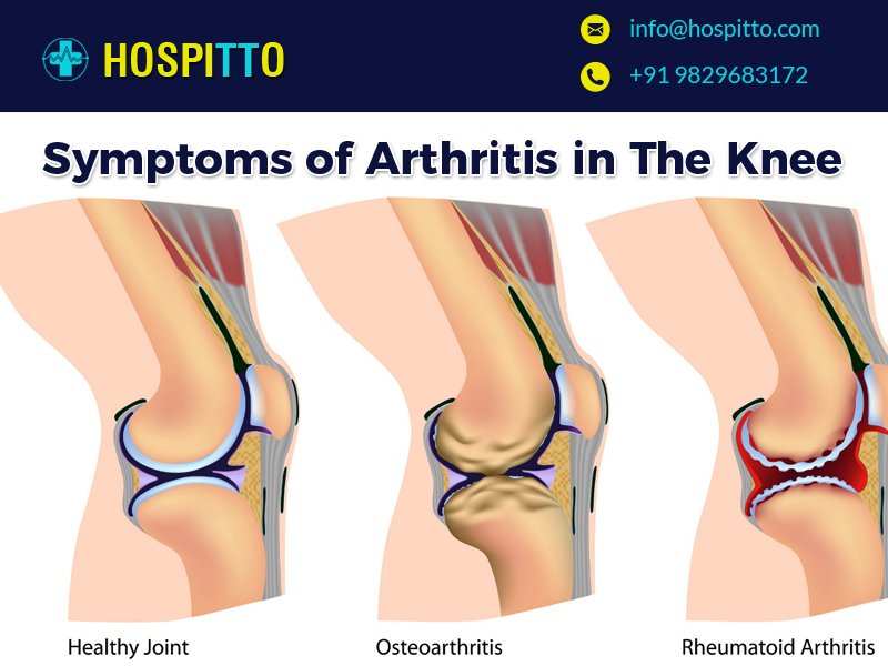 hospitto's tweet photo. If you feel pain in your knee joints consistently then it is time to consult an orthopedic Doctor in Jaipur.
https://t.co/qJtfdRUizG
#pain #joints #knee #consult #doctor #bestDoctors #jaipur #orthopedic #arthritis https://t.co/DUOLyW2zGm