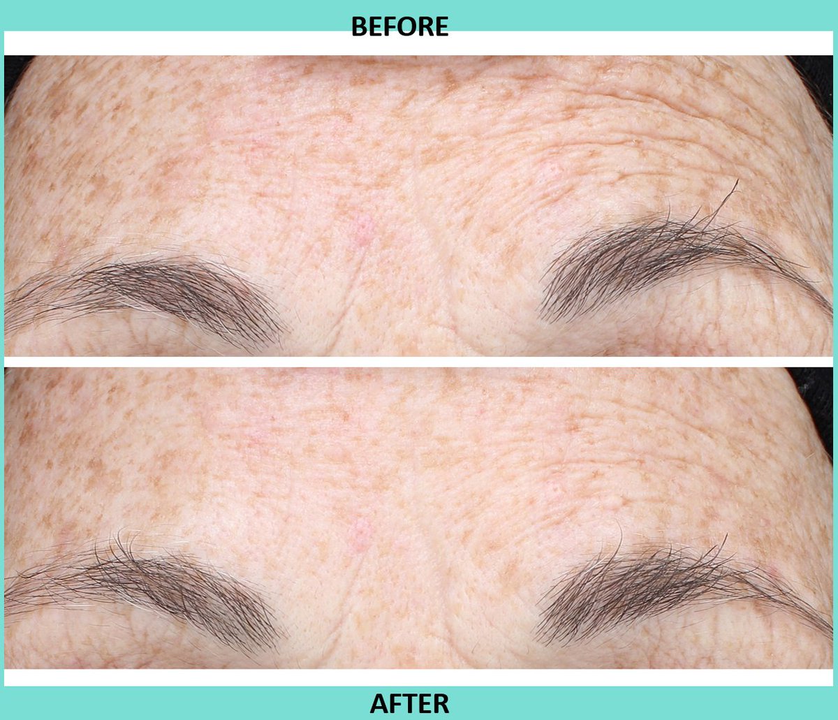 nowmi_treatment's tweet image. Sun damage is the #1 cause of aging skin.  With the  NowMi treatment you can get rid of sun spots quickly &amp;amp; easily. It takes only 5 minutes and as you can see from the picture below, in only 6 treatments there was a reduction in the sun spots. 
Visit: ow.ly/5Qzc30jE0y1