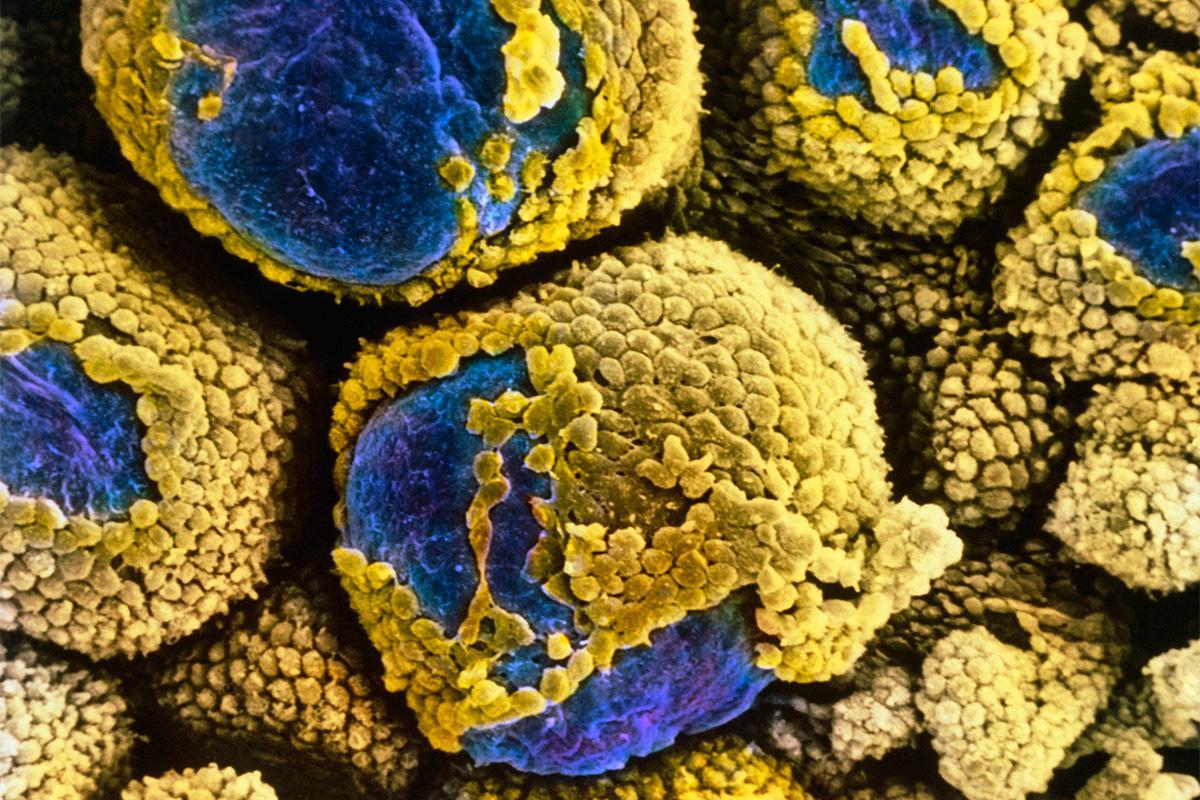 newscientist's tweet photo. Cause of polycystic ovary syndrome discovered at last https://t.co/OAlQWyeXH2 https://t.co/rqilJ4hjnj