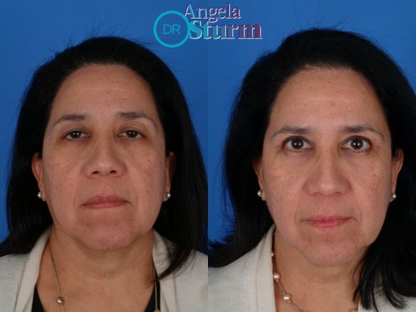 DrAngelaSturm's tweet photo. It's amazing how a straightforward, quick procedure like an upper eyelift (blepharoplasty) can give the whole face a refreshed look!  We tend to look other people's eyes first and look for cues about vitality, energy and interest in the conversation. https://t.co/n3lSSL4S5L