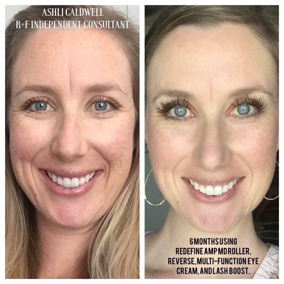 barbgirl1999's tweet image. #TheBestSpentMinuteInSkincare is 20% off right now!  Use it alone, or pair it with a regimen to AMP up your results! No need to make expensive micro-needling appointments...get the same results at home, on YOUR schedule 💙💛💜❤️💚 #RFTeamGoalDiggers #RFTime4Me2Fly