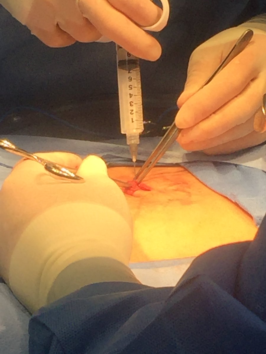 ColumbiaSurgery's tweet photo. Can you guess the procedure happening here? Hint: one pair of hands belongs to Dr. @NovitskyYuri 💉 https://t.co/pv4NEudmzr