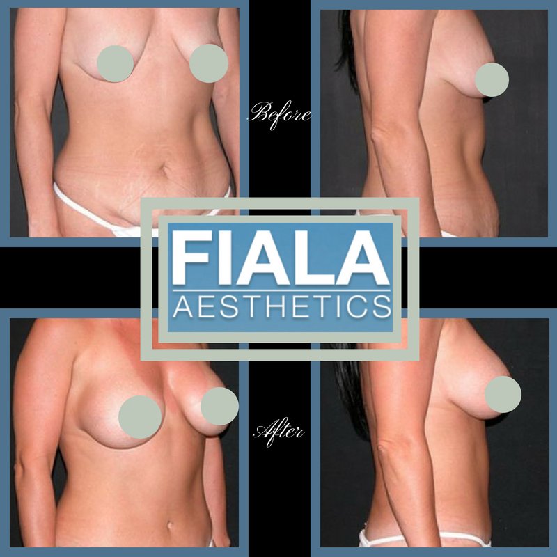 drfiala's tweet photo. This #TransformationTuesday #MommyMakeover patient had #TummyTuck, #BreastImplants and Circular #BreastLift at #FialaAesthetics -An amazing #transformation!
https://t.co/pO81mwWIHg
#MakeOver #MommyMakeover #HotMom #BodyPositive #BabyBody #FitMom https://t.co/tDTqPTvj8J
