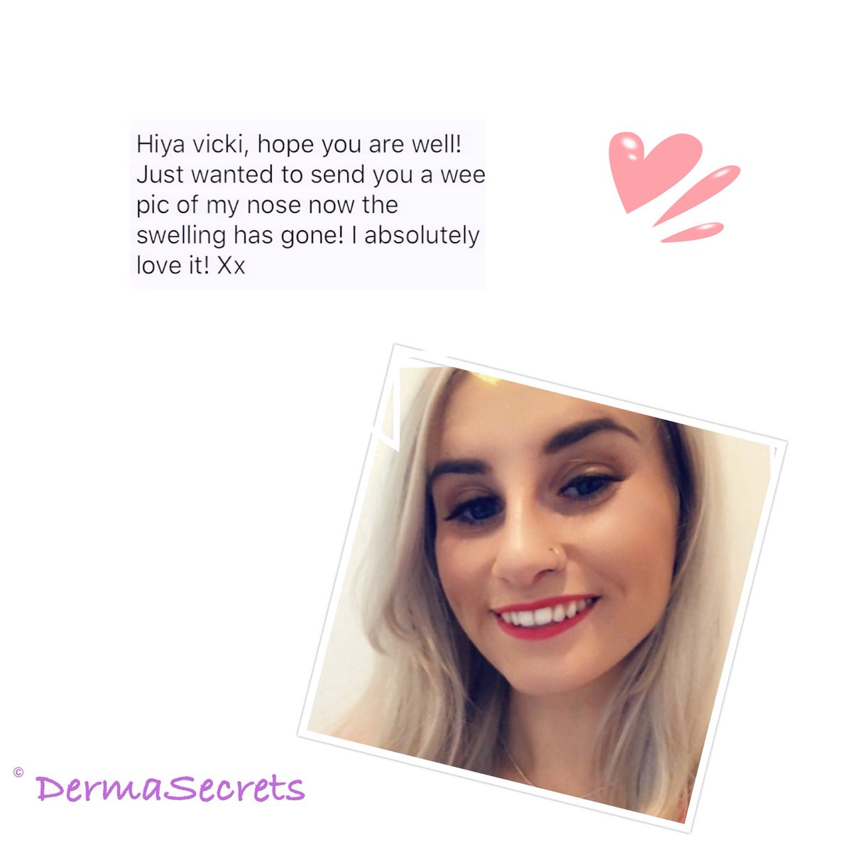 derma_secrets's tweet photo. We always like client selfies and feedback! #dermasecrets #aesthetics #doctor #edinburgh #glasgow #westlothian #dermalfillers #nose #rhinoplasty #nonsurgicalnosejob #nonsurgicalrhinoplasty #results #feedback #selfie #love #dermadolls https://t.co/jf2lI425ZP