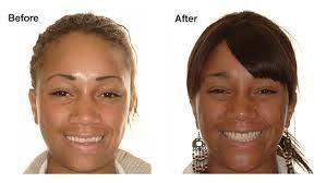 DrGorczyca's tweet image. Open bites can be corrected!  #bites #openbite #orthodontics #orthodontist