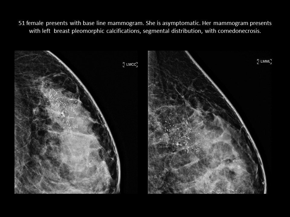 Cleveland Breast Imaging Education On Twitter Clecod3 Comedonecrosis