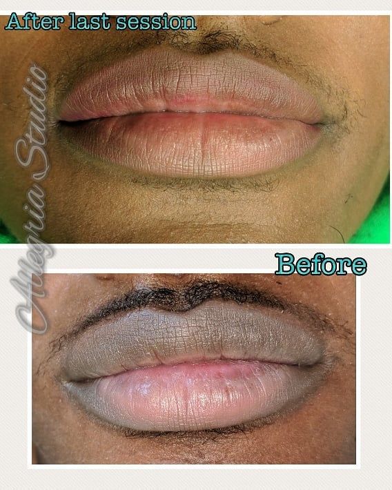 lip pigmentation treatment