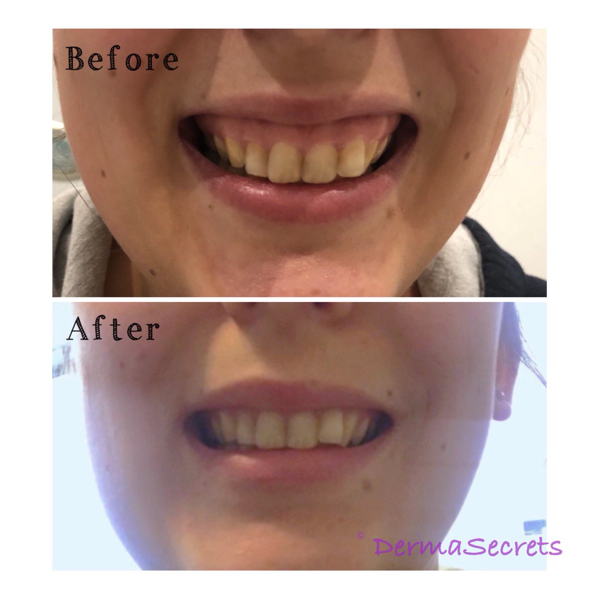 derma_secrets's tweet photo. Gummy smile correction! Love this result 😘 #aesthetics #edinburgh #glasgow #doctor #smile #gummysmile #gummysmilecorrection #happy #confidence #teeth #beauty #beautiful #thelittlethings #whynot #bestself #smileforthecamera #dermasecrets https://t.co/CPVVMlDDqo