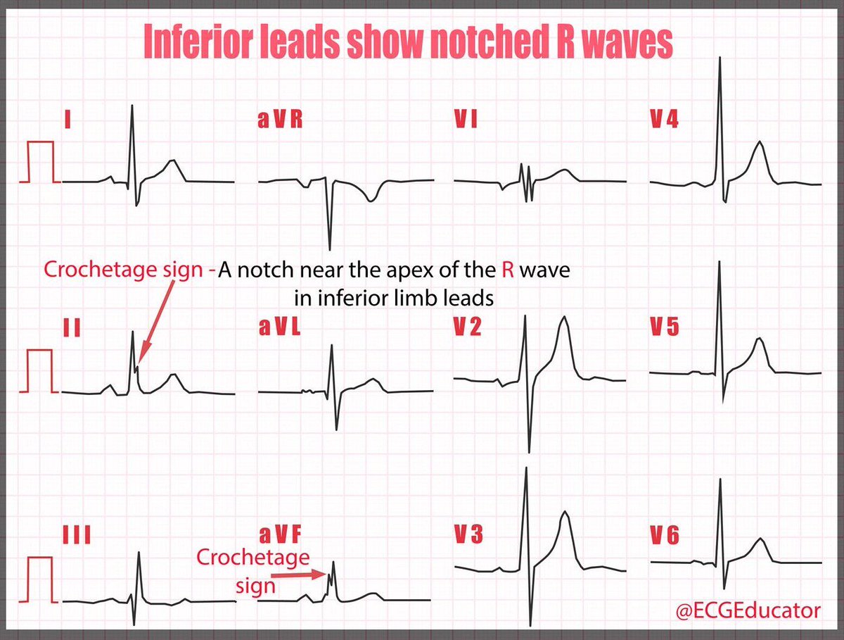 Crochetage pattern in the III and aV F leads