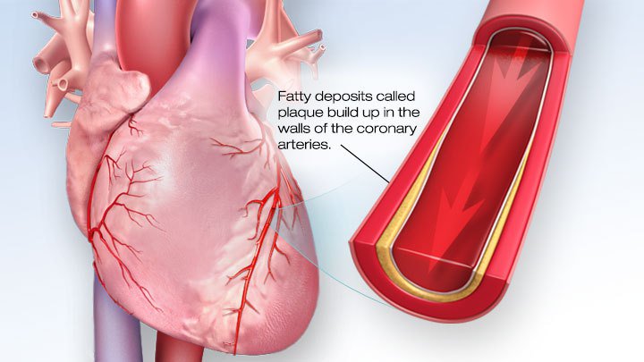 হার্ট অ্যাটাক healthbanktips.com/%e0%a6%b9%e0%a…