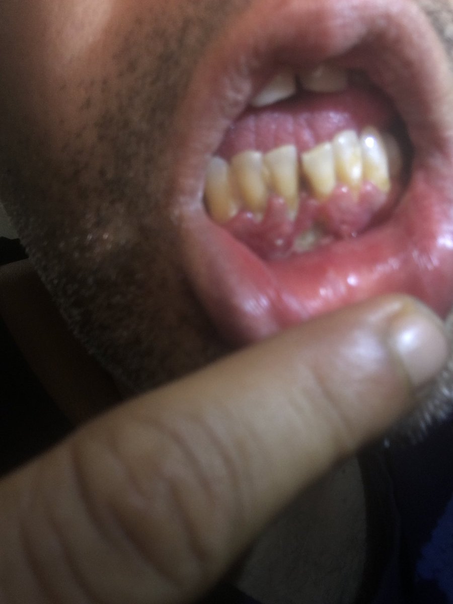 narjizing's tweet photo. Cancer necrotic hole in gum green aug 2017 https://t.co/msbR0MtNaH