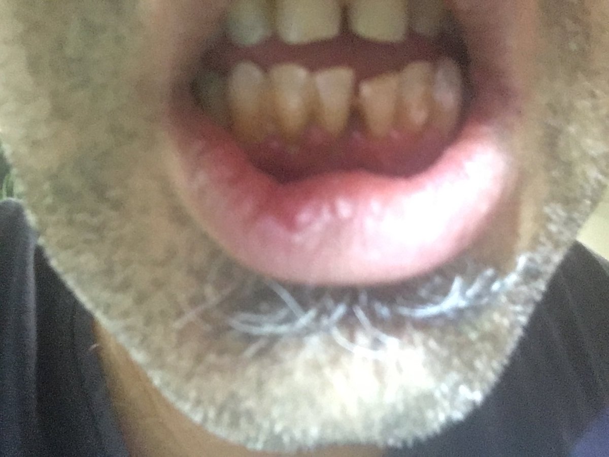 narjizing's tweet photo. May 11, 2918 No green stinky puss cancer necrosis and healthy healing red gum tissue after once daily application of marijuana oil for 6 months https://t.co/2PiChjQLS4