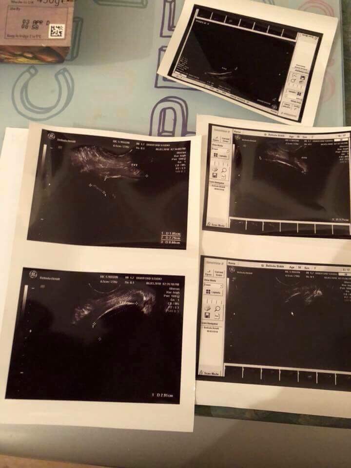 belinda89175024's tweet photo. When your surgeon at Oxford tells bad lies in saying she’s got all of the TVT mesh tape out via key hole surgery, I go for a translibial scan still got pieces in me! TRUST never again! @waelagur @MeshCampaign @SlingtheMeshNI @Jeremy_Hunt @theresa_may @CMO_England https://t.co/AP4KIrMBLr