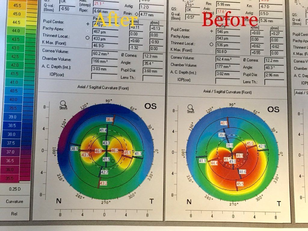 OpSupAssc's tweet photo. Treatment of #keratoconus is evolving - before & after corneal topography 1mth after corneal wavefront guided laser trans epithelial PRK combined with #Avedro rapid crosslinking. Before is a typically keratoconic cornea & after looks like a normal eye with astigmatism @your_2eyes https://t.co/JezIG36cv3