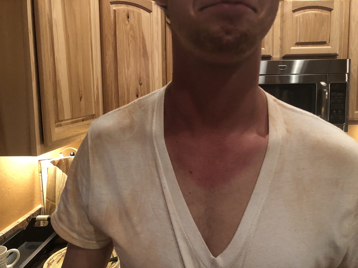 MAB_Sedona's tweet photo. #BURNT this AZ sun taught us a hard lesson at service yesterday.. apply sunscreen about every 5 minutes. #HERETOSERVEANDGETBURNT https://t.co/AcBjNuQbhQ