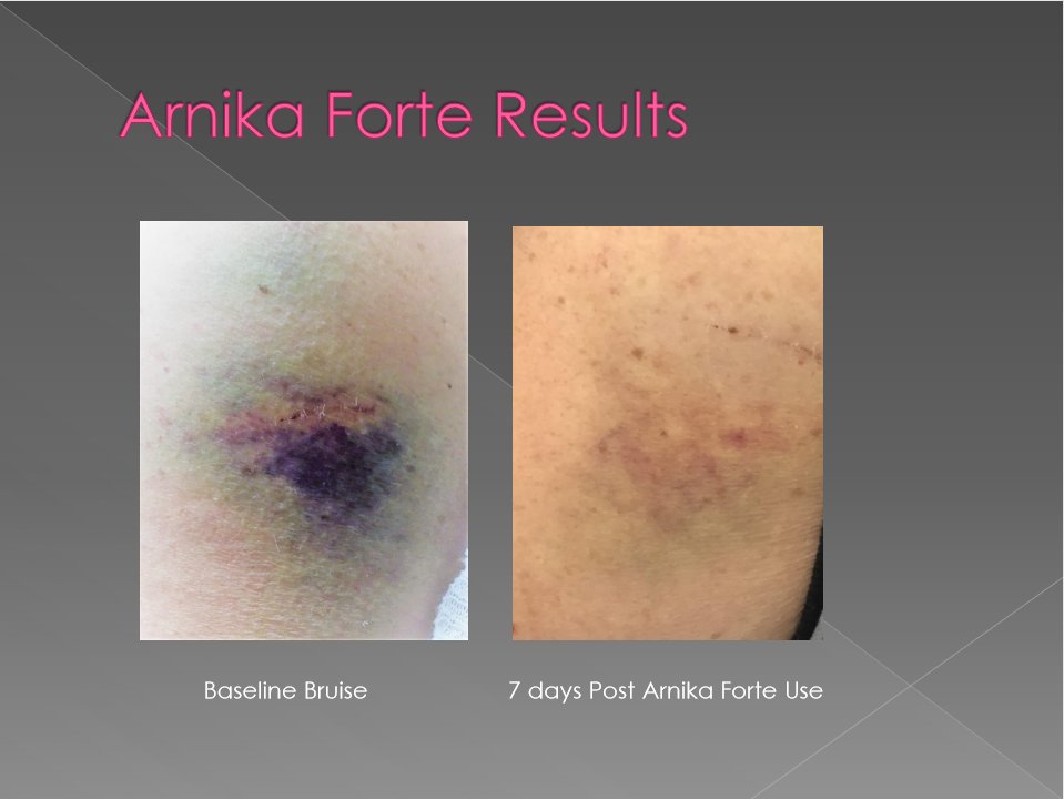 Arnika Forte ® (DermAvance)
