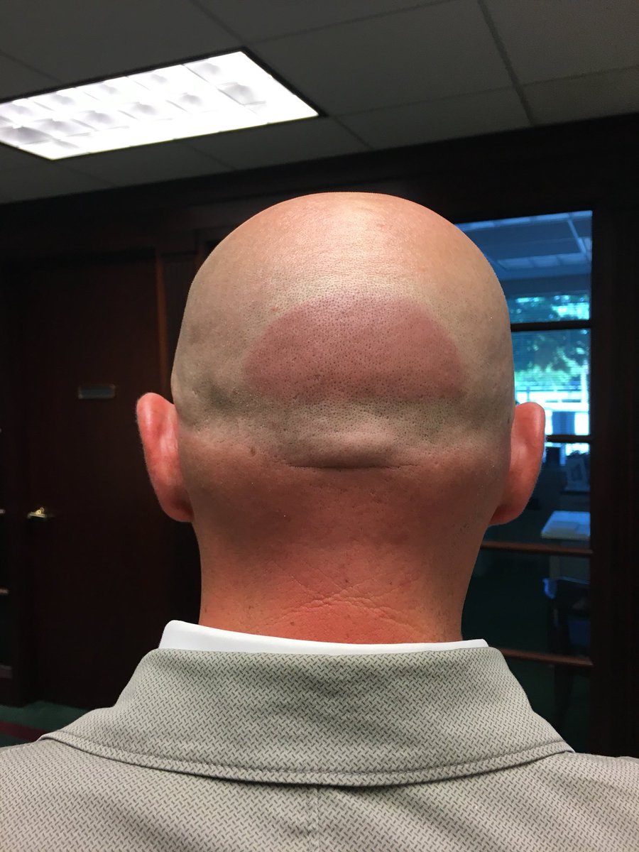mabieryan's tweet photo. Two days of building a new deck led to two things 1. An awesome deck &amp; 2. A really unfortunate tan line.  #baldisbeautiful #hatline https://t.co/oh2hnsHMlR