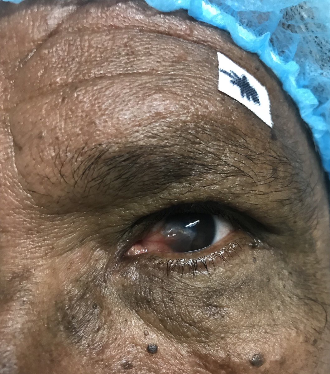 El pterigio es una patología ocular de alta prevalencia en países tropicales , en casos avanzados puede ser causa de ceguera .<a href="/MinSaludCol/">MinSalud Colombia 🇨🇴</a>