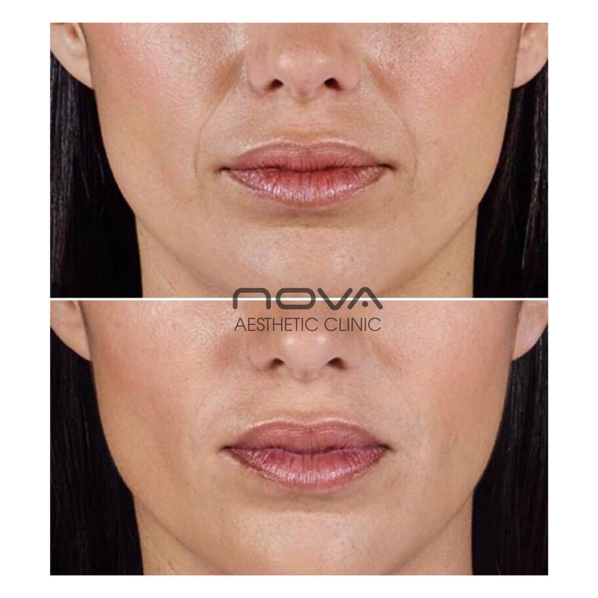✨DERMAL FILLER at Nova✨ Filler can be used to soften and fill deep wrinkles, such as the parentheses corner (by the side of the nose) and the marionette lines (also known as laughter lines). The results speak for themselves. #juvederm #london #greenwich #dermalfiller #flawless