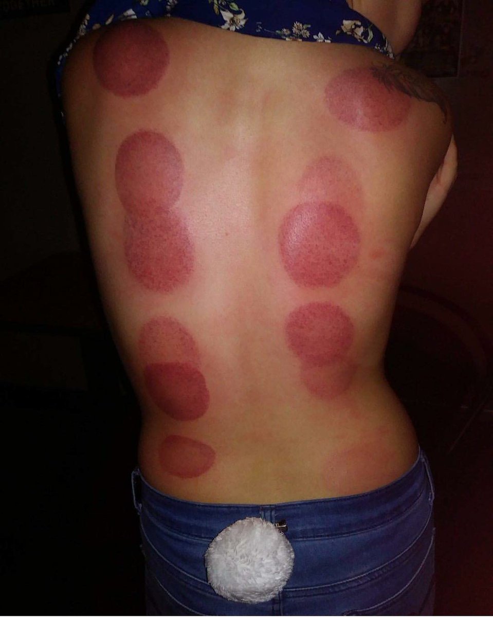 MisterpeterPain's tweet photo. After firecupping lovebugxmiliion. #bdsm #cupping #fire #firecupping #Entertainment #retweet #FollowMe https://t.co/CF7TvhstXz